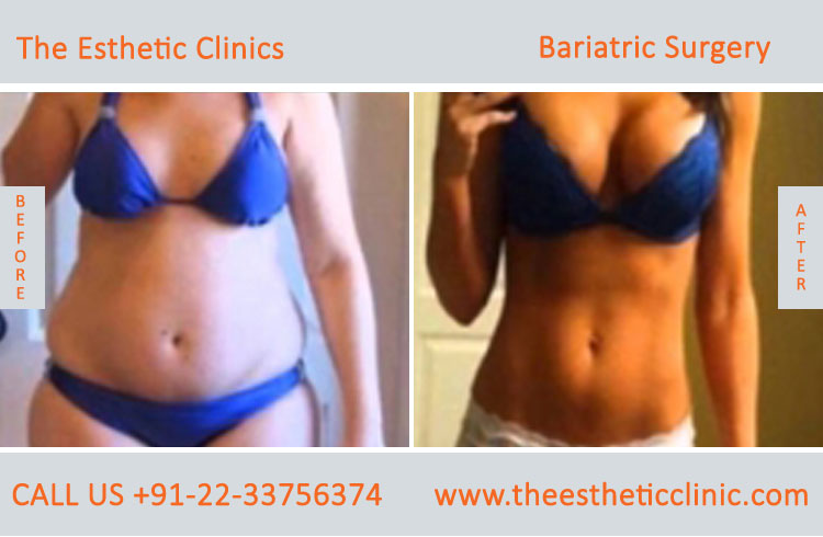 Bariatric Surgery, Weight Loss Surgery before after photos in mumbai india (6)